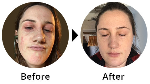 Before and after: red, irritated eczema patches on a woman's face, cleared