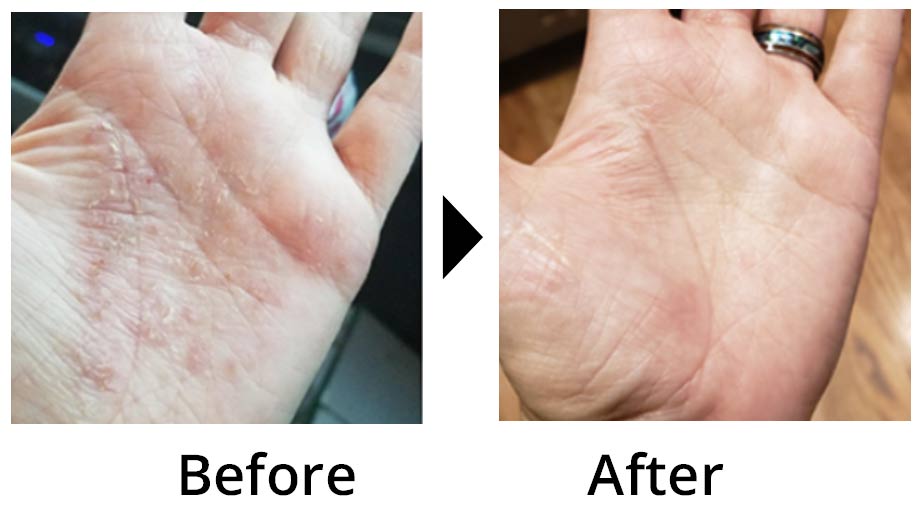 Before and after: eczema on the palm of the hand, cleared