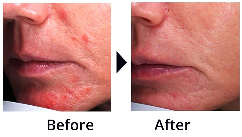 Before and after: seborrheic dermatitis redness beside the nose and mouth, cleared